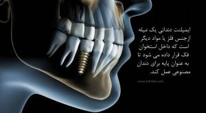 Implants Smilewithme Smile Designers by Jacqueline Rojas Villaobos Emergency Esthetic Extracion