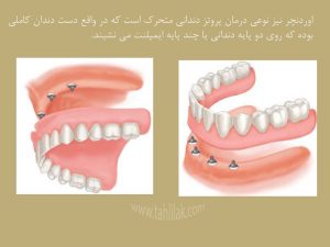 dental implant supported denture 33278835